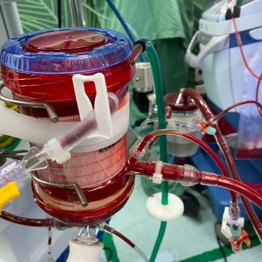 Pediatria se destaca com uso de ECMO em crianças em estado crítico